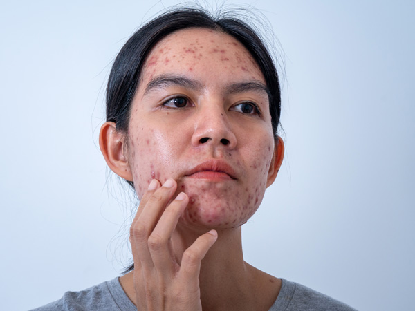 woman with severe facial acne