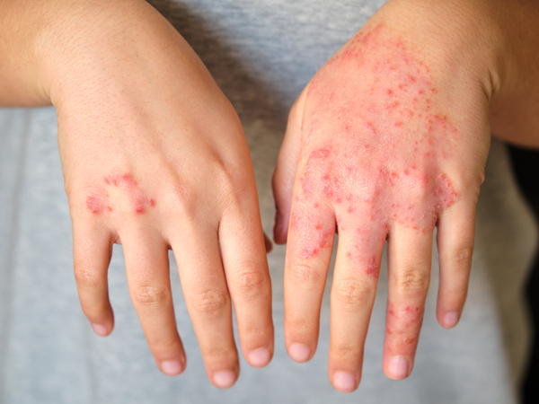 patient with eczema on their hands