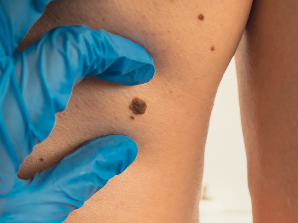 doctor examining a patient's mole