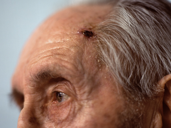 elderly man with skin cancer on forehead